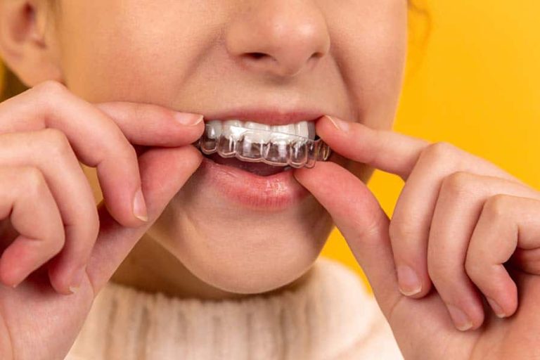 How To Make Your Retainer Fit Again At Home