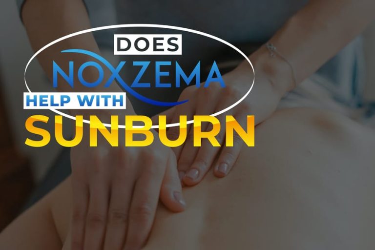 Does Noxzema help with sunburn?